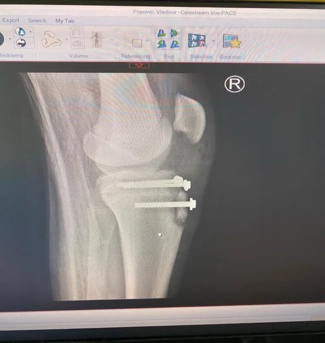 Tibia plateau fracture in a young basketball player